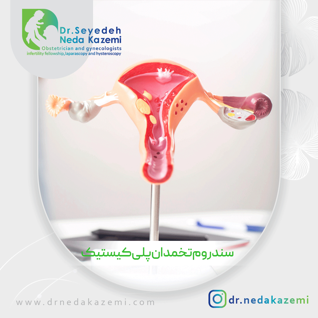 سندروم تخمدان پلی کیستیک